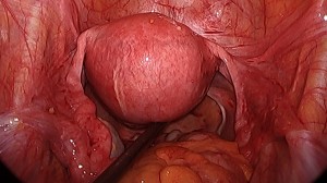 Uterus with no adhesions from robotic surgery
